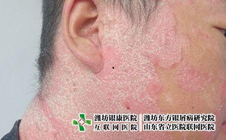 癣图片大全,常见类型及症状一览