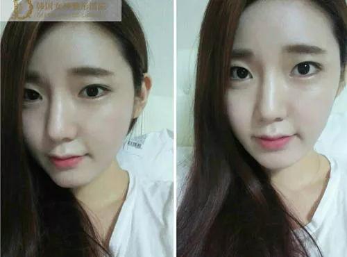 韩国女生整容前,素颜下的自然美